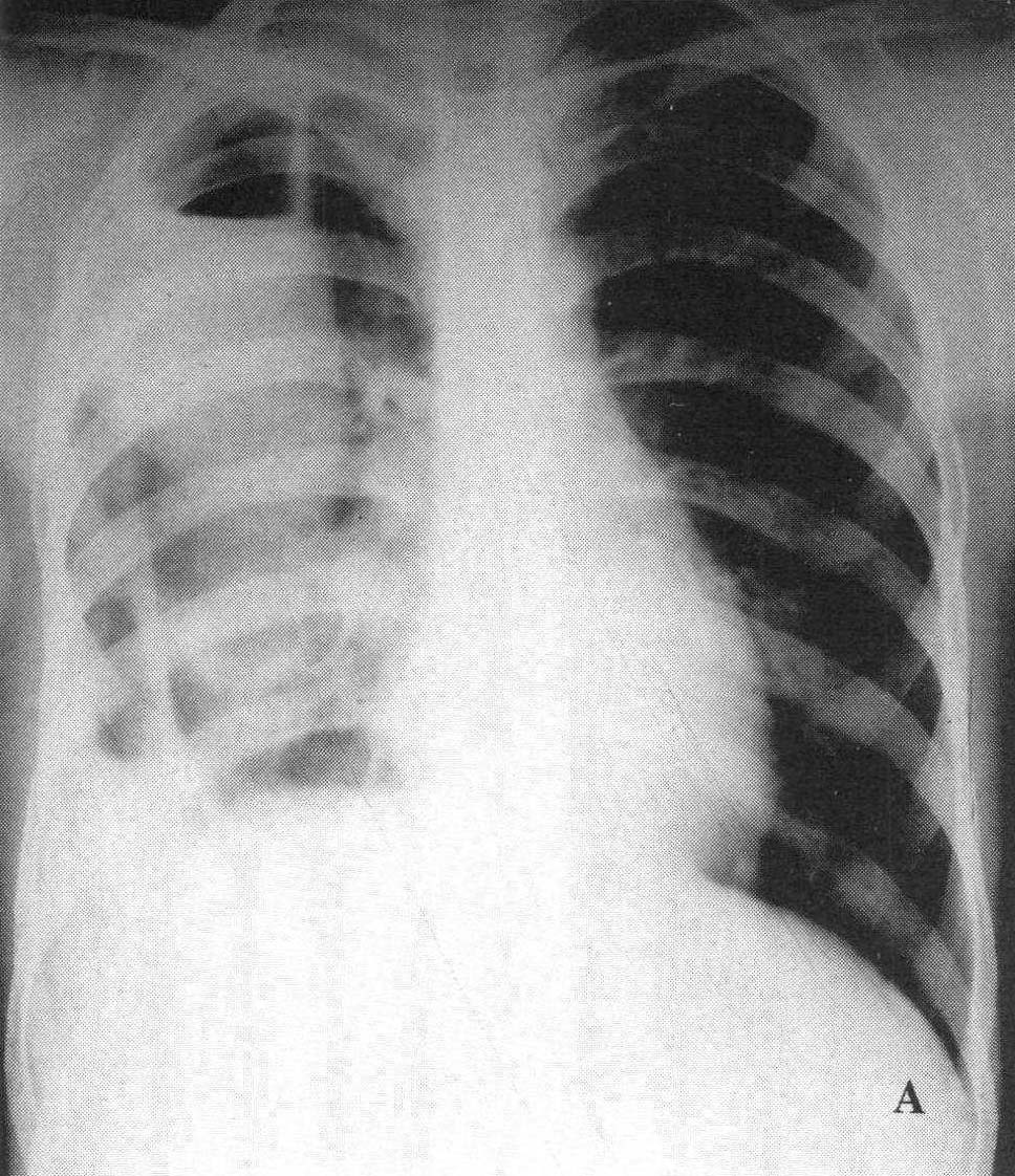 图2—259 肺化脓症